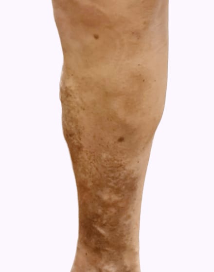 The same lower leg after treatment, with the ropey veins flattened
