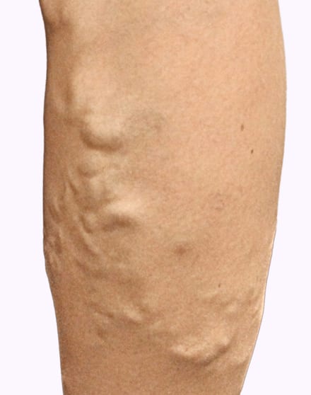 A calf with raised, twisted varicose veins before treatment