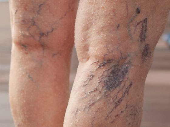 Fine red and purple spider veins on a leg