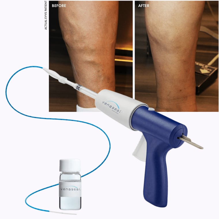 The VenaSeal delivery device and adhesive beside a before and after of an actual Empire Vein & Vascular patient's leg